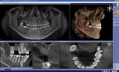 ConeBeam CT scan
